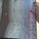 震惊！老人体内竟长达40cm